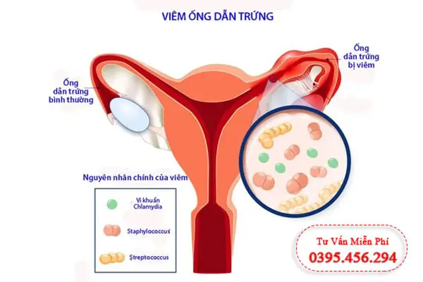 Hình ảnh viêm nhiễm âm đạo do viêm ống dẫn trứng