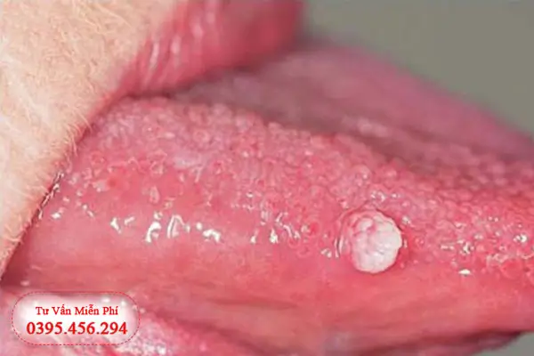 Hình ảnh sùi mào gà ở lưỡi giai đoạn đầu