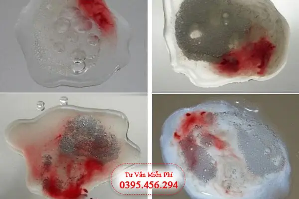 Phương pháp chẩn đoán và cách điều trị xuất tinh ra máu