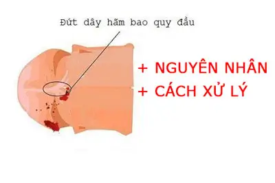 Bị đứt dây hãm bao quy đầu