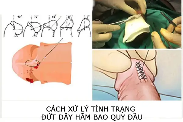Cách xử lý tình trạng đứt dây hãm bao quy đầu
