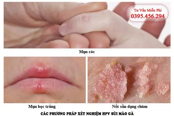 Các phương pháp xét nghiệm HPV sùi mào gà