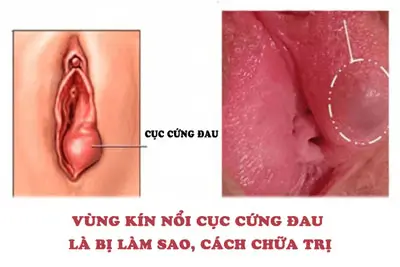 Vùng kín nổi cục cứng đau là bị làm sao, cách chữa trị