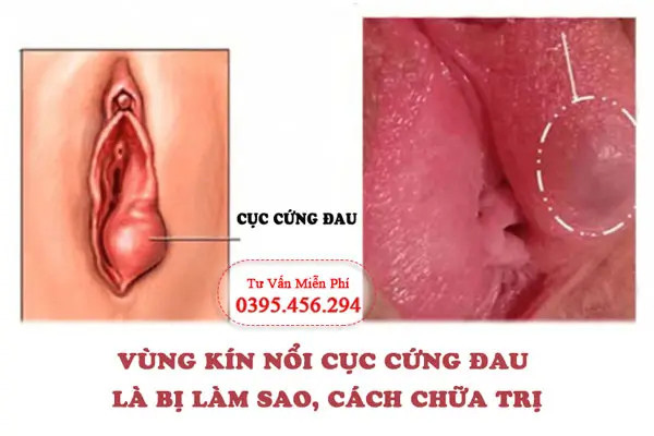 Vùng kín nổi cục cứng đau là như thế nào?