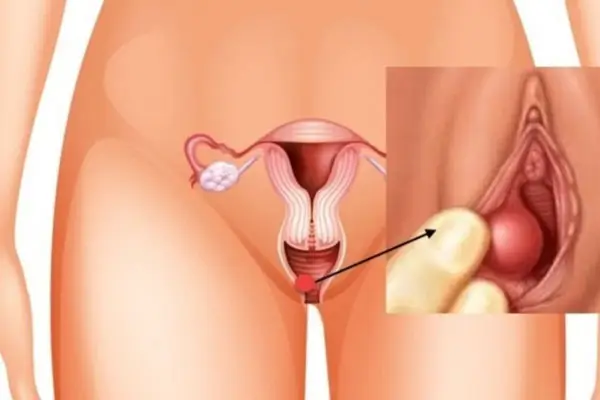 Cách chữa trị vùng kín nổi cục cứng đau