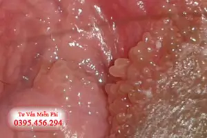 Hình ảnh mụn gai sinh dục nữ chi tiết trên người thật