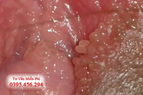 Hình ảnh mụn gai sinh dục nữ chi tiết trên người thật