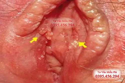 Hình ảnh mụn gai sinh dục nữ trên người thật