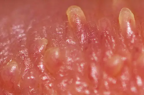 Hình ảnh mụn gai sinh dục rên người thật