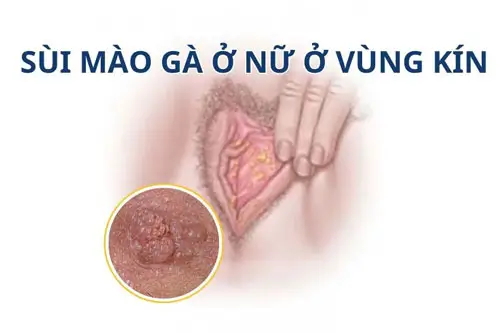 Hình ảnh sùi mào gà trên người thật