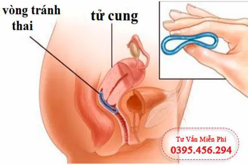 16 Địa chỉ đặt vòng tránh thai ở đâu tốt và uy tín tại Hà Nội