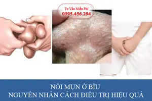 Nổi mụn ở bìu nguyên nhân cách điều trị hiệu quả