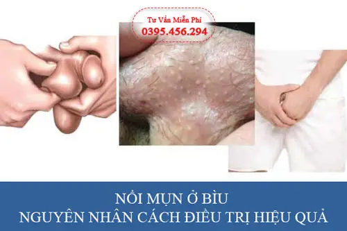 Nguyên nhân gây ra nổi mụn thịt ở bìu