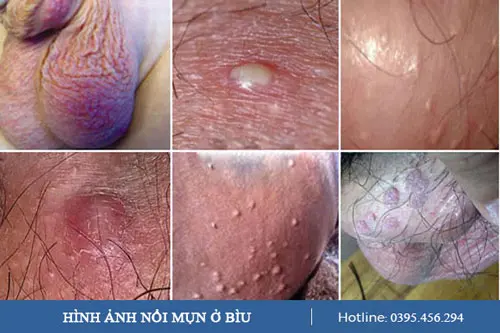 Hình ảnh gây ra nổi mụn thịt ở bìu