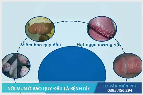 Nguyên nhân và triệu chứng nổi mụn ở bao quy đầu