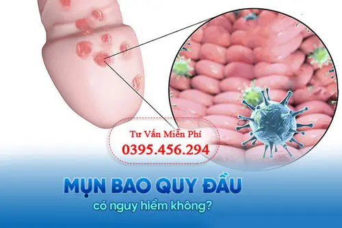 Nổi mụn ở bao quy đầu là bệnh gì?