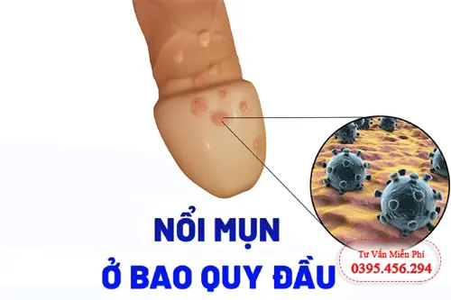 Bệnh lậu gây nổi mụn ở bao quy đầu