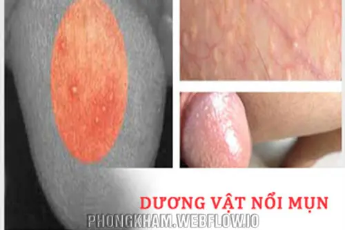 Điều trị nổi mụn ở bao quy đầu tại cơ sở y tế uy tín