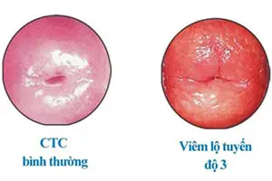 Chi phí điều trị viêm lộ tuyến cấp độ 3 bảng giá 2025