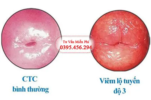Bệnh viêm lộ tuyến cấp độ 3