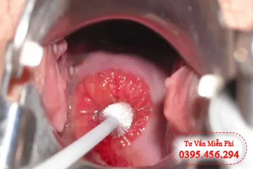 Bảng giá chi phí điều trị viêm lộ tuyến cấp độ 3