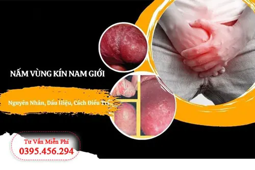 Nấm vùng kín là gì?