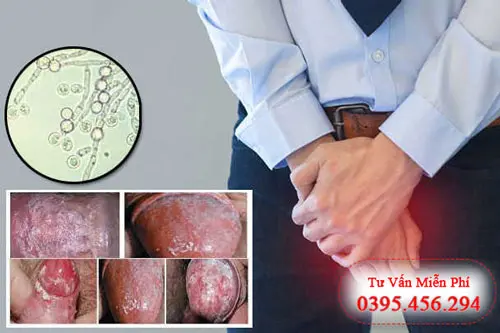 Hình ảnh nấm vùng kín ở nam giới