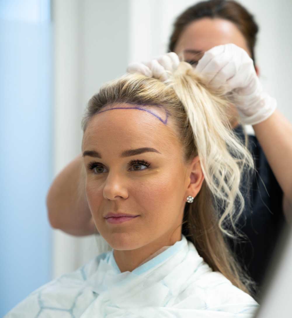 En man får sin nya hårlinje ritad.