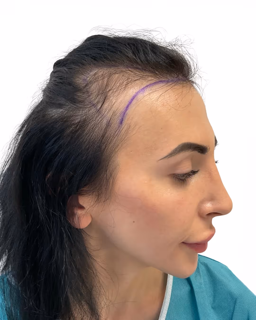 Ines före hårtransplantationen