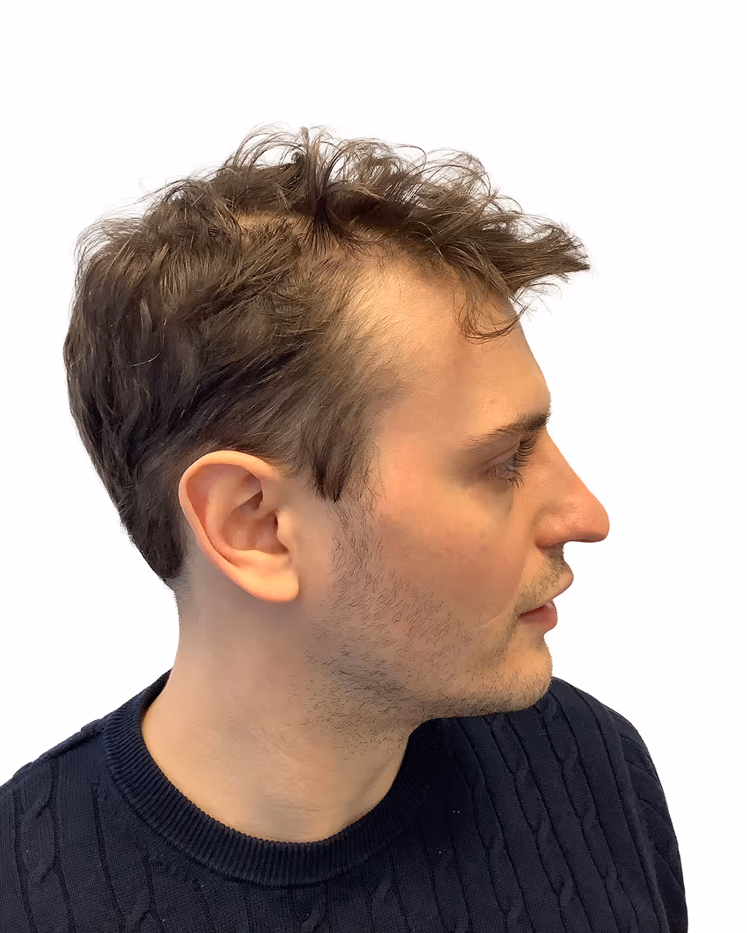 Valentin före hårbehandlingen