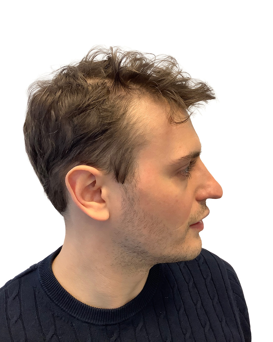 Valentin före hårbehandlingen