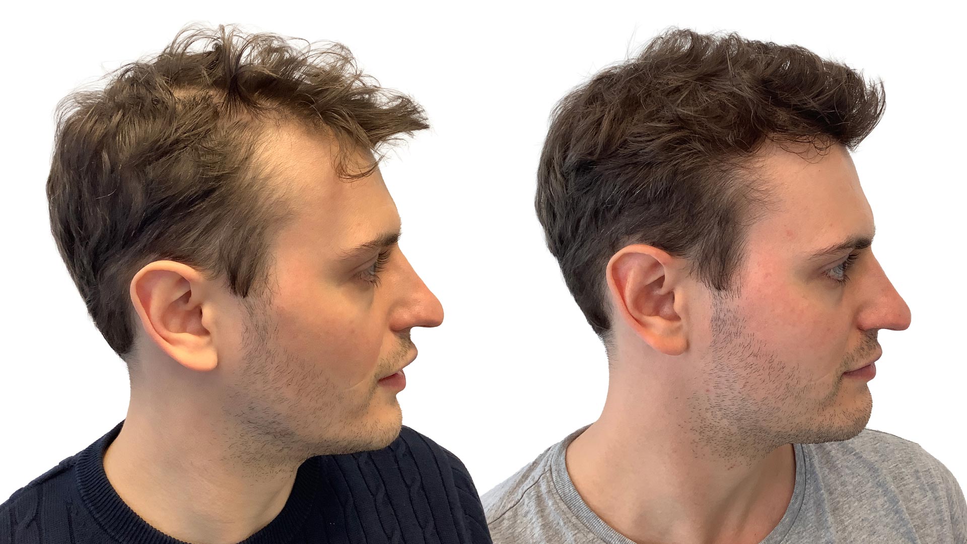 Valentin – före och efter sin hårbehandling