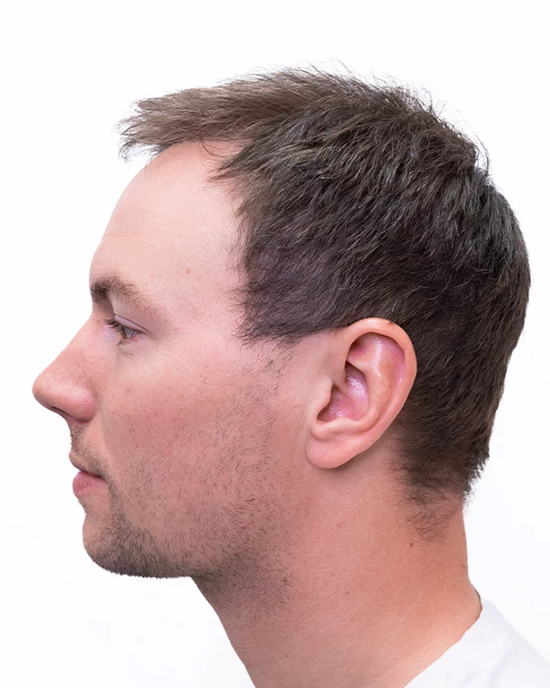 Tobias efter hårtransplantationen