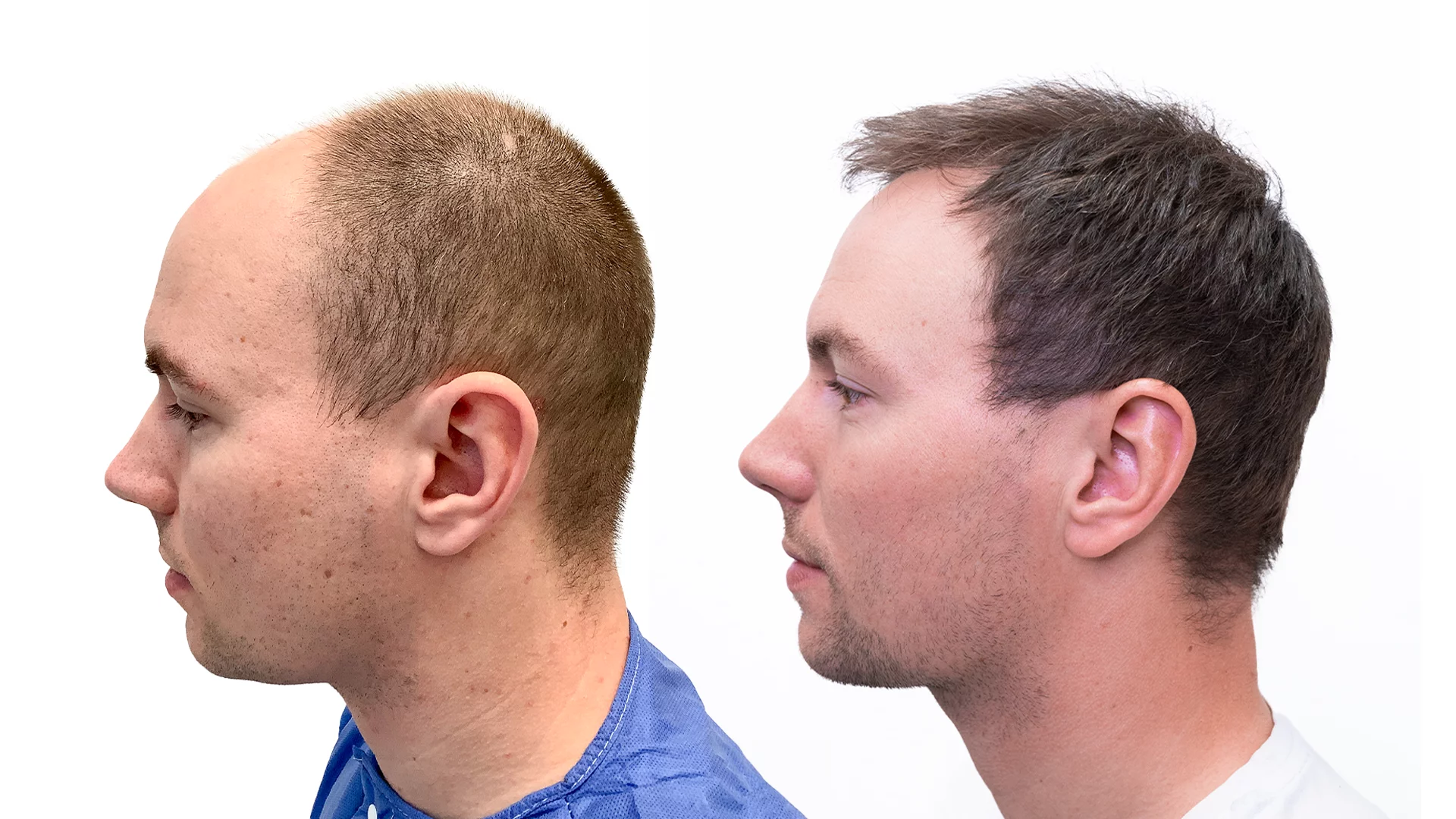 Tobias – före och efter sin hårtransplantation