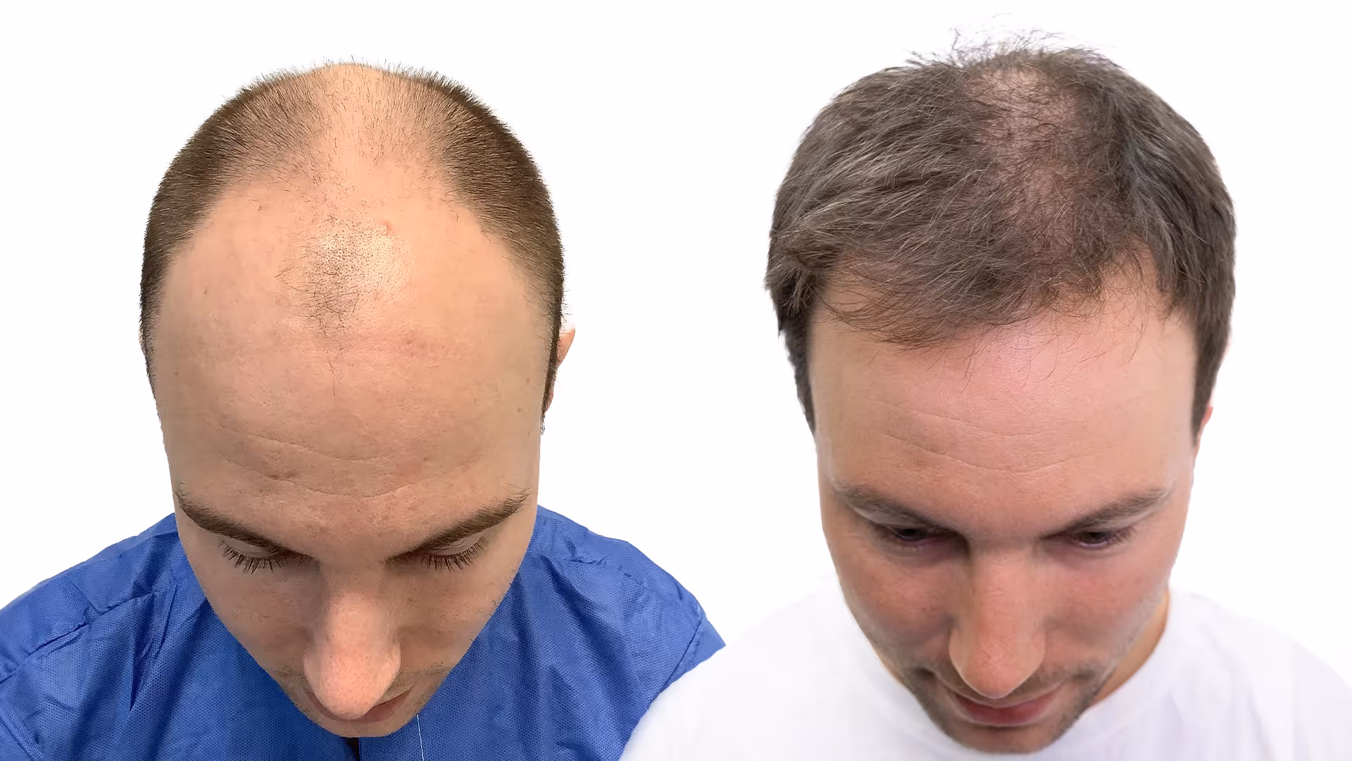 Tobias – före och efter sin hårtransplantation