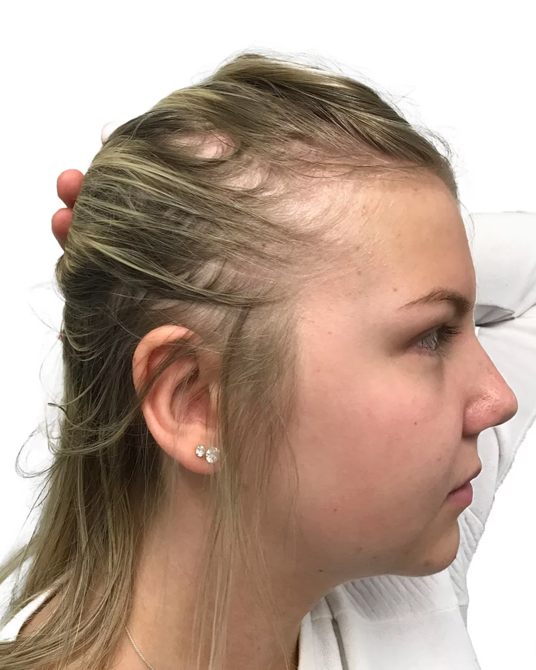 Thilda före hårbehandlingen