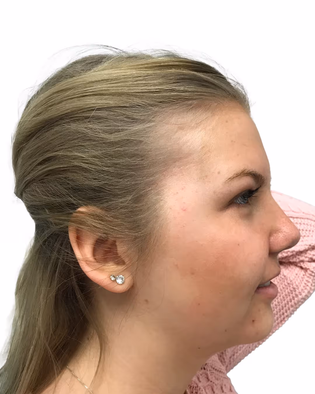 Thilda efter hårbehandlingen