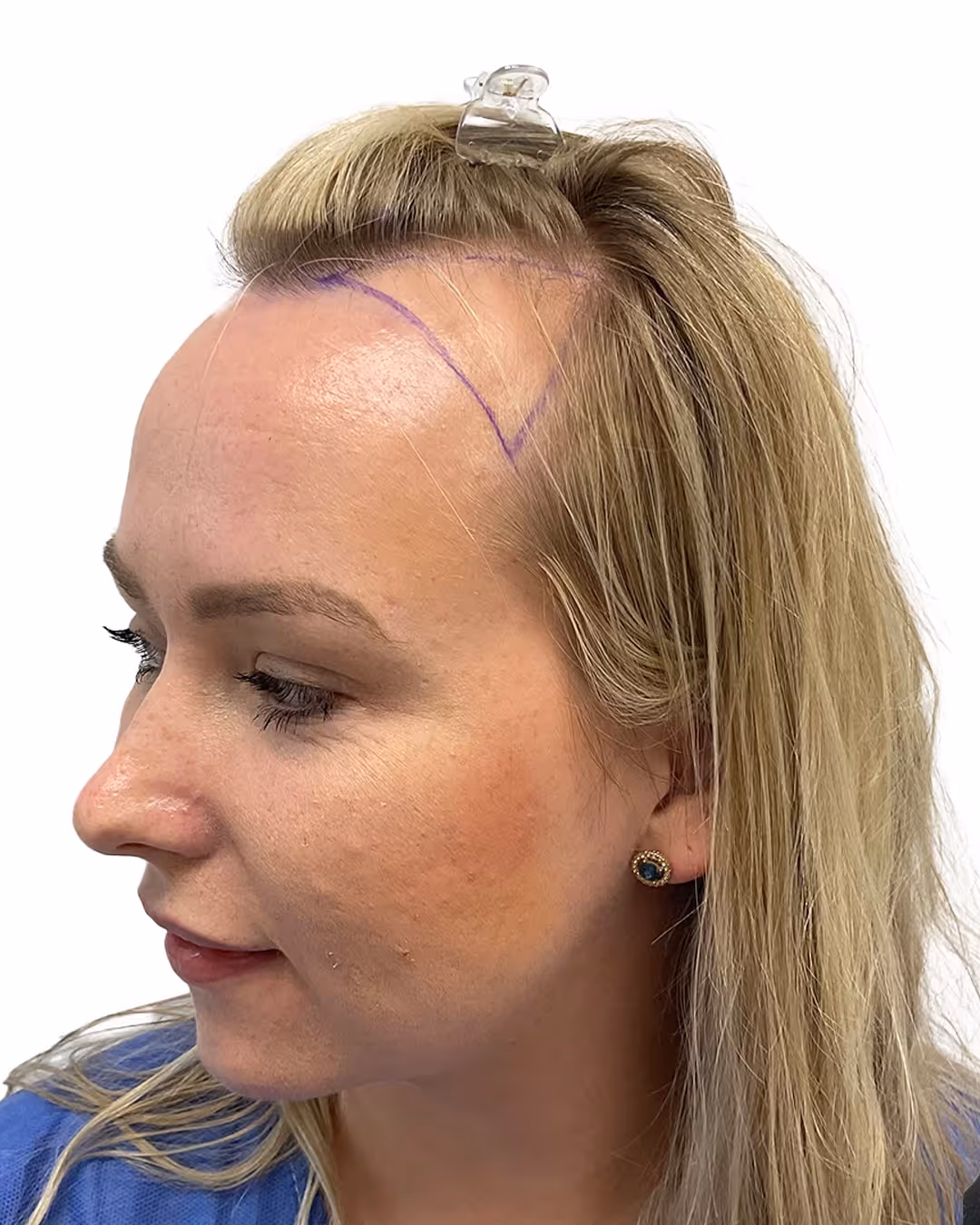 Therese före hårtransplantationen