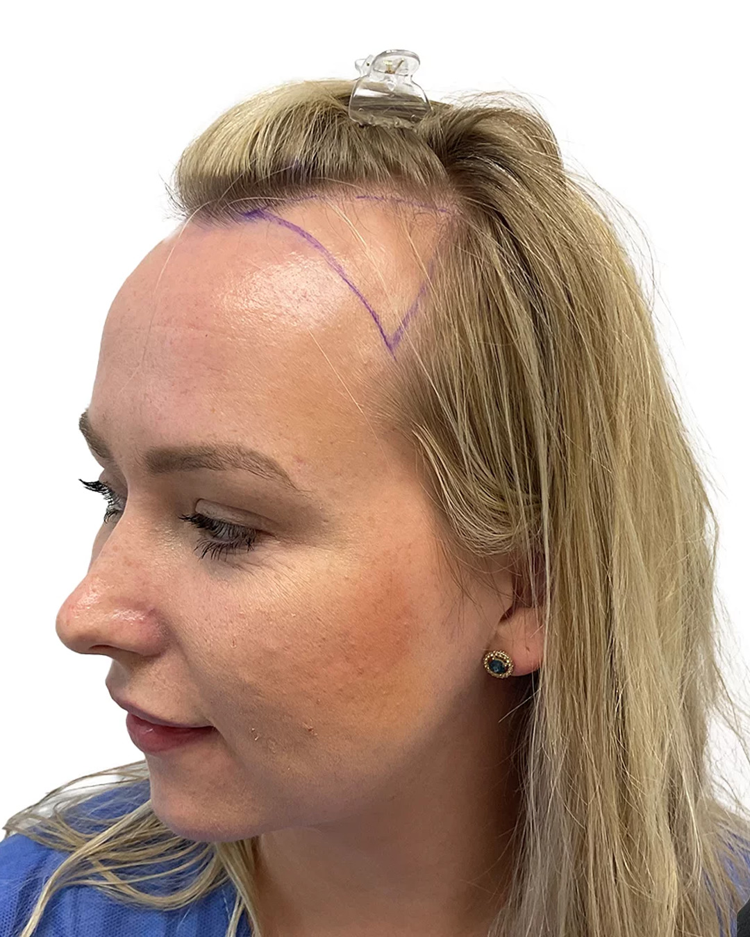 Therese före hårtransplantationen