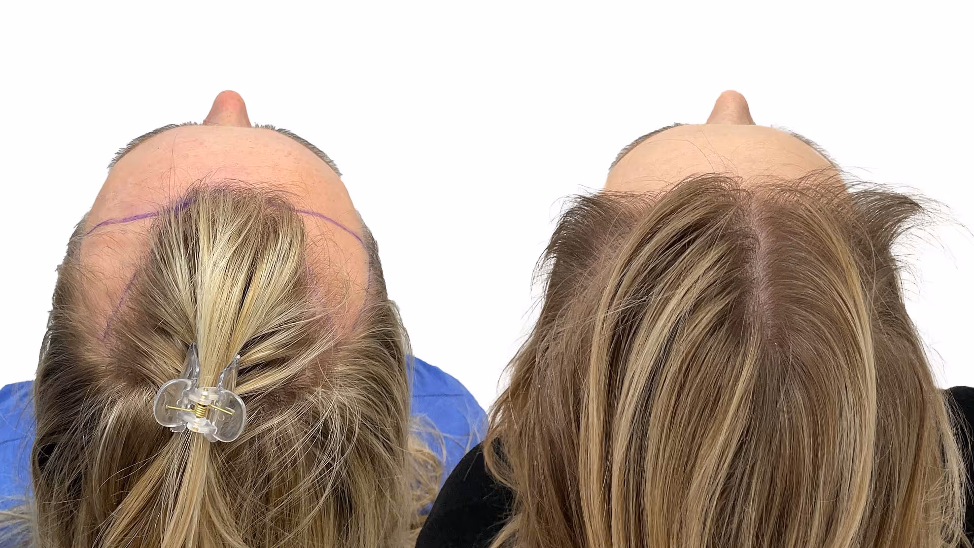Therese – före och efter sin hårtransplantation