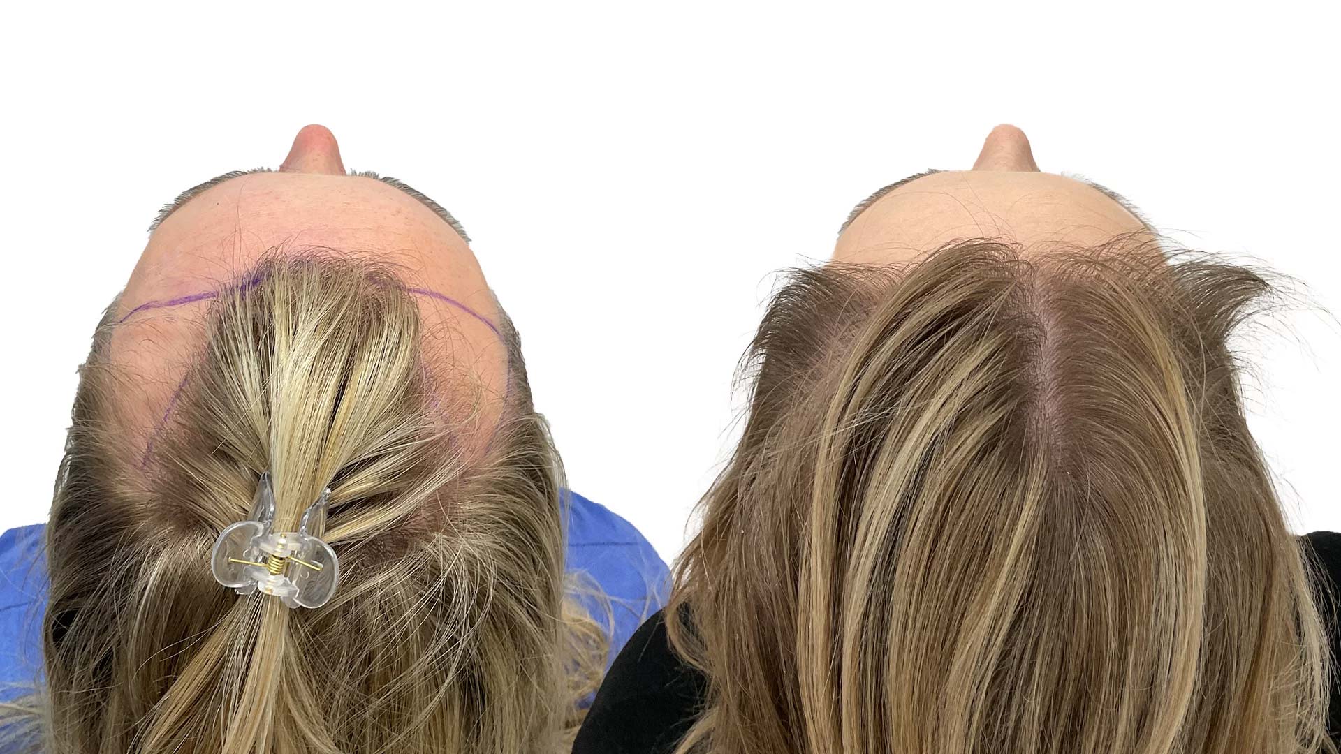 Therese – före och efter sin hårtransplantation