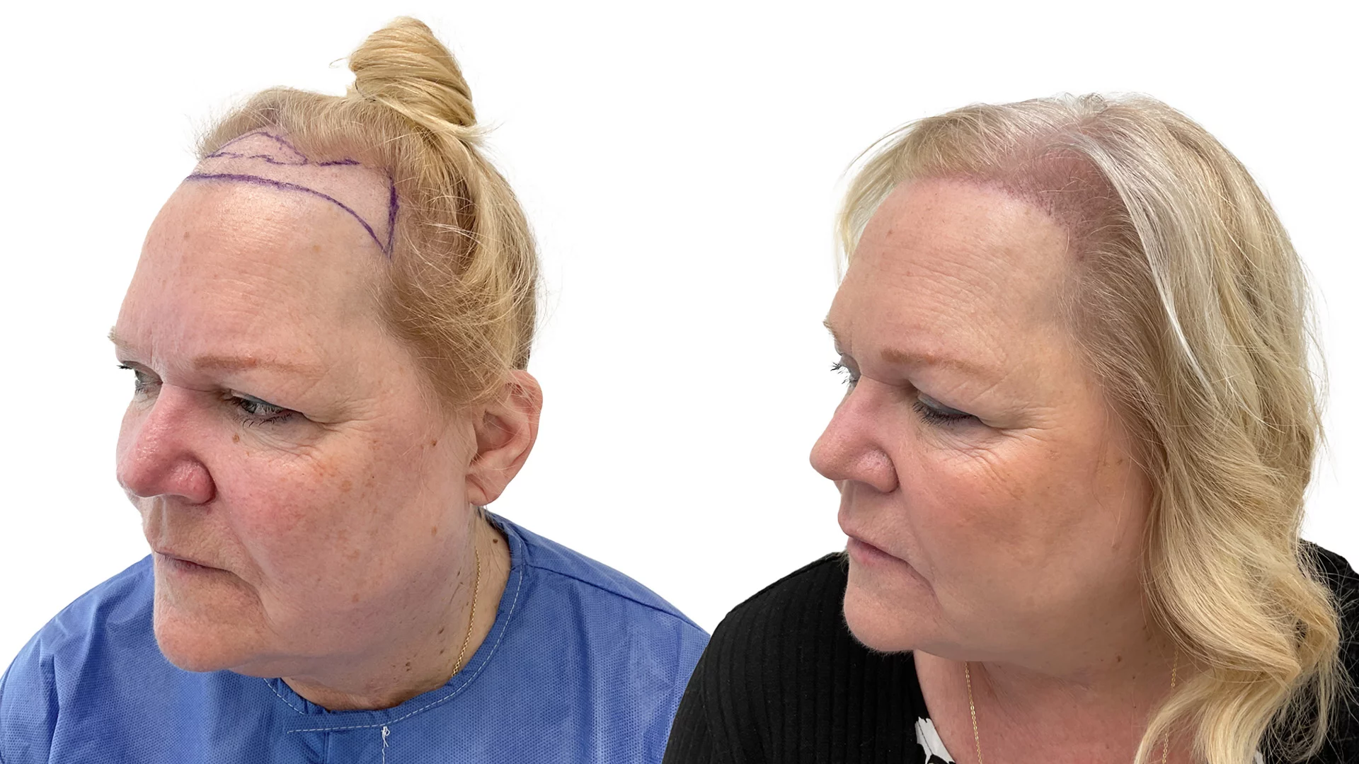 Susanne – före och efter sin hårtransplantation