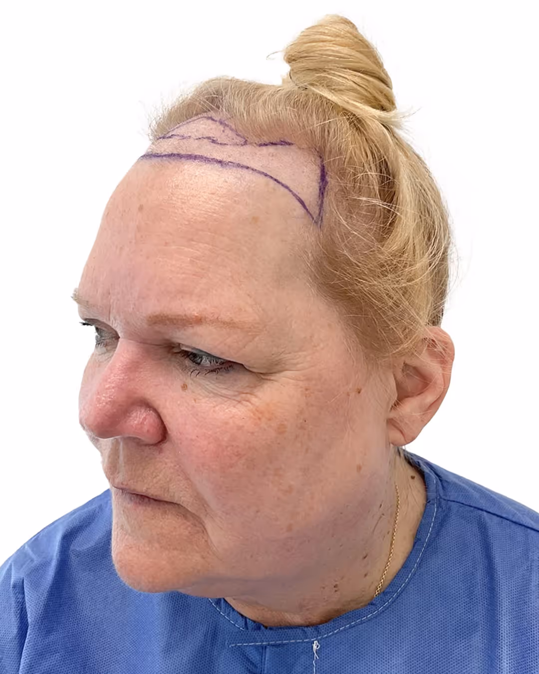Susanne före hårtransplantationen
