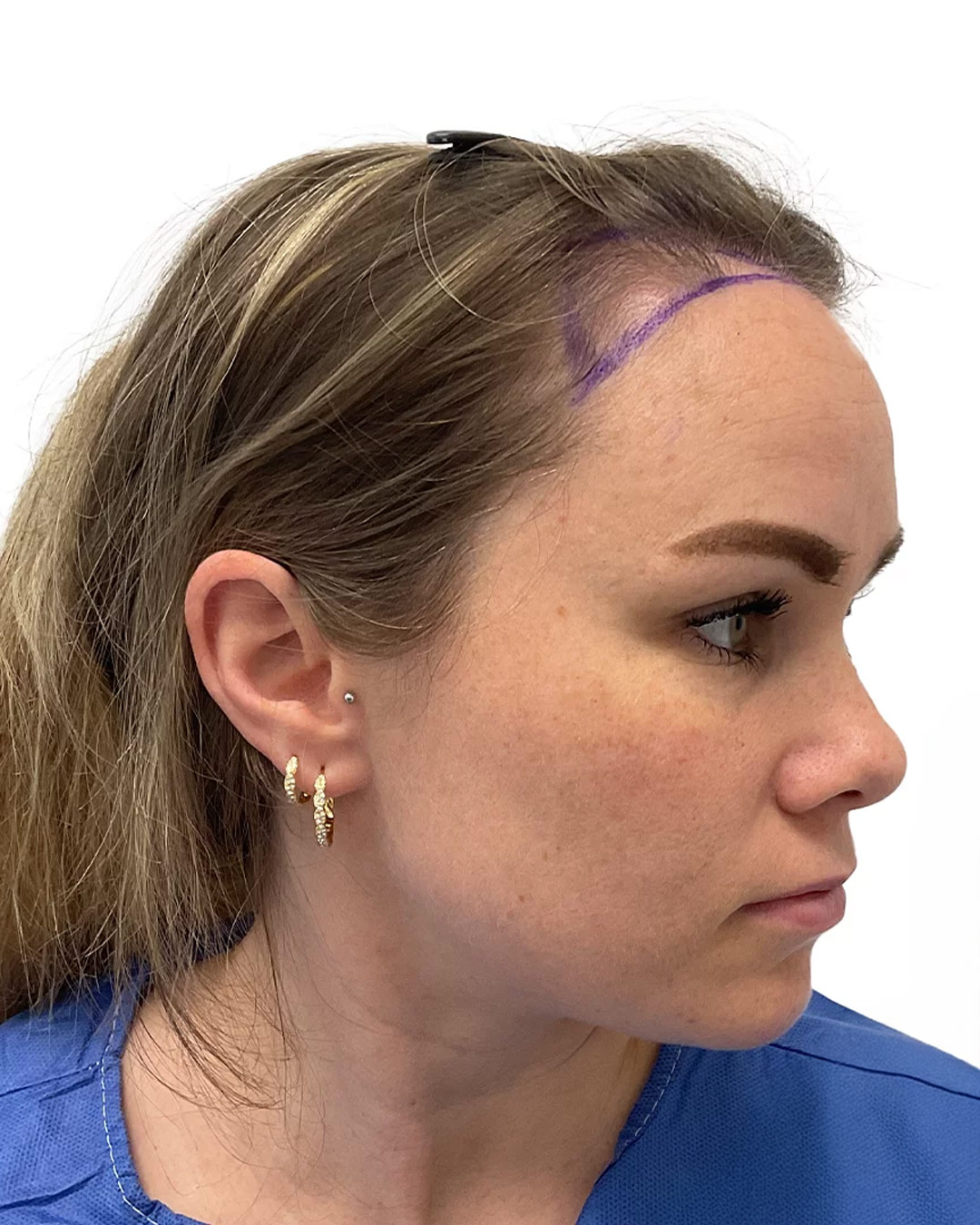 Sofia före hårtransplantationen