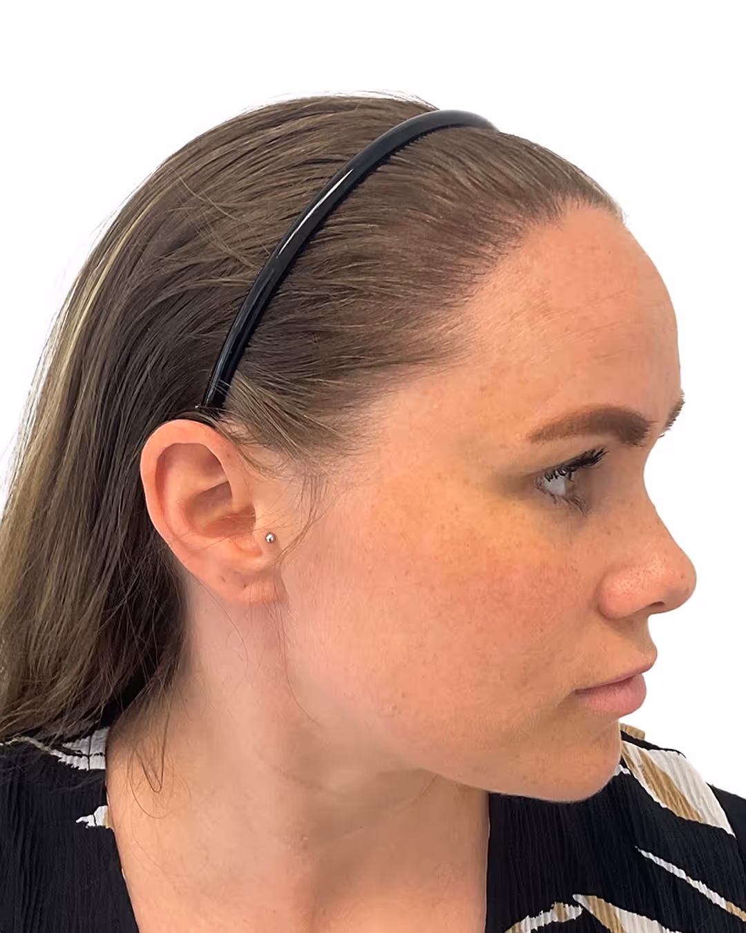 Sofia efter hårtransplantationen