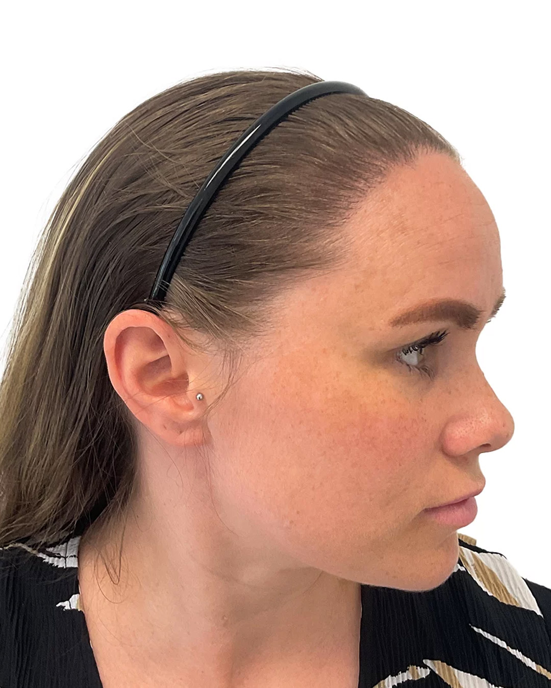 Sofia efter hårtransplantationen