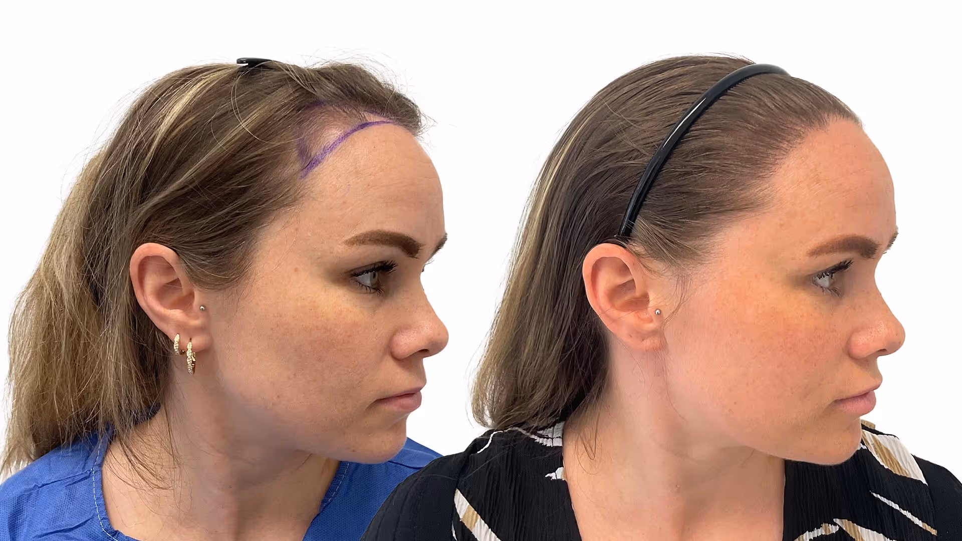 Sofia – före och efter sin hårtransplantation
