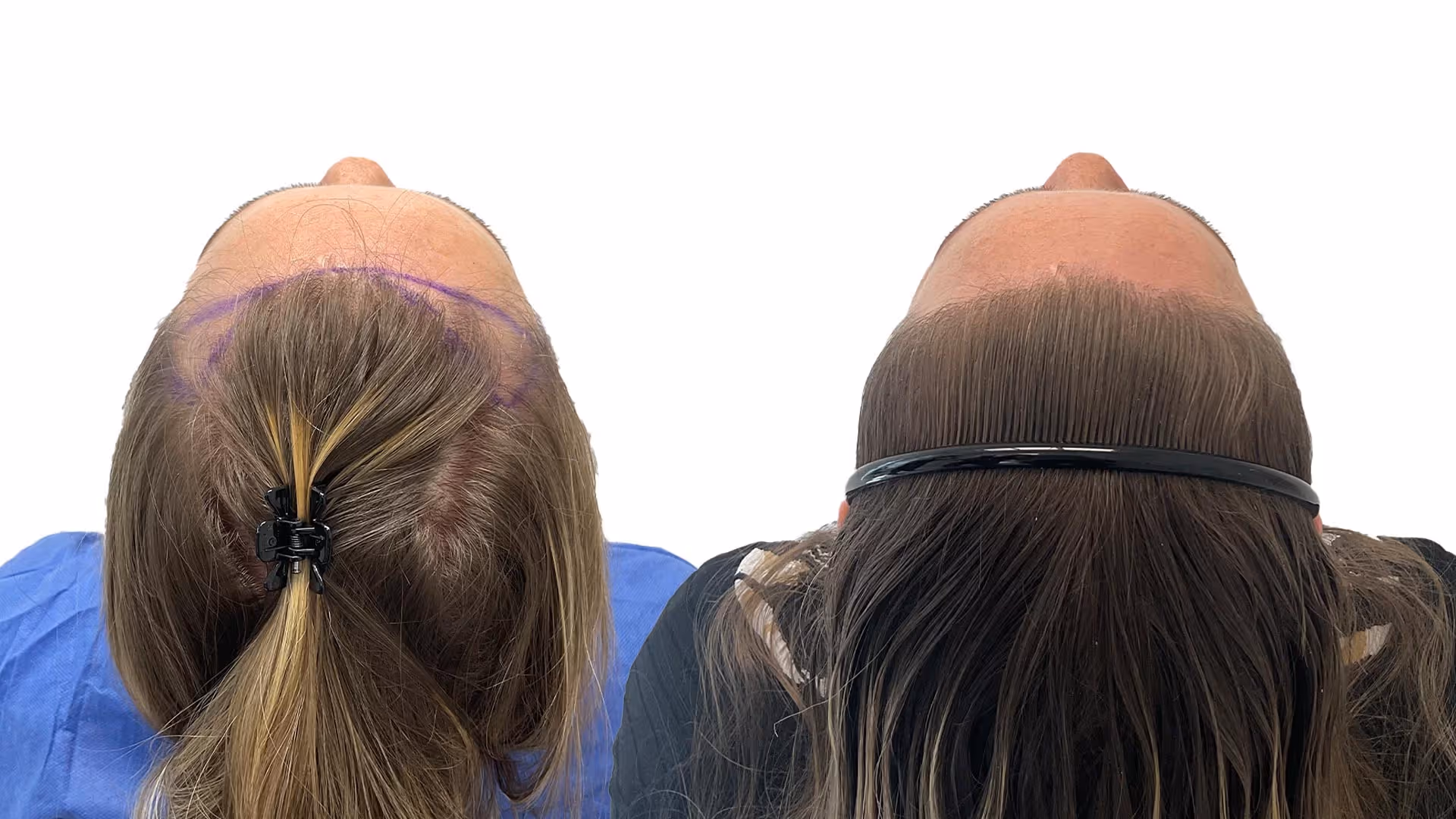 Sofia – före och efter sin hårtransplantation