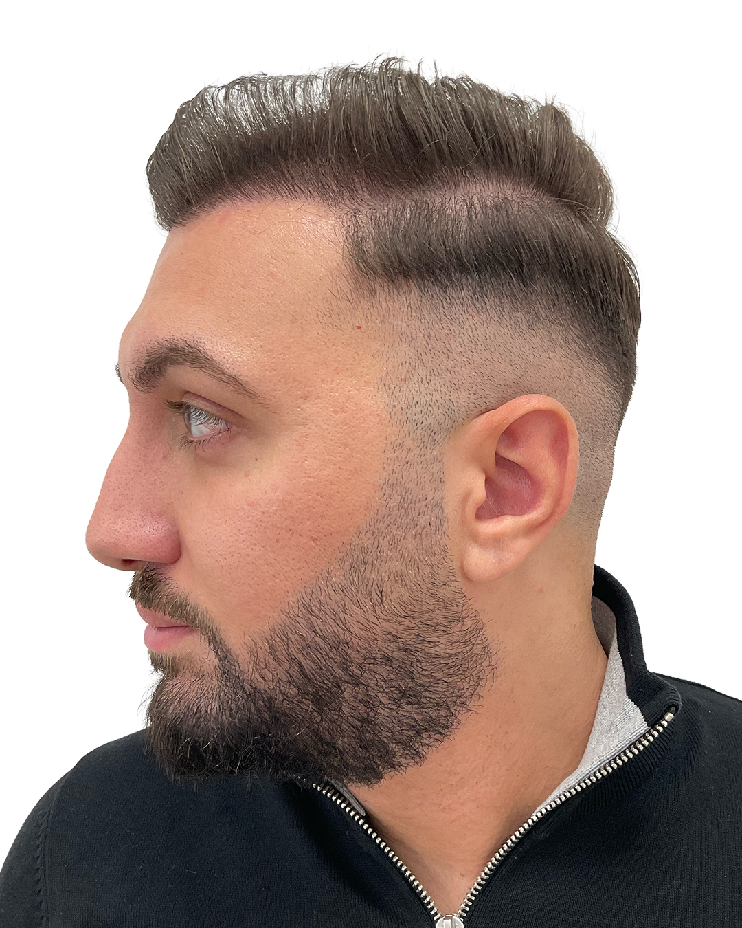 Simon efter hårtransplantationen