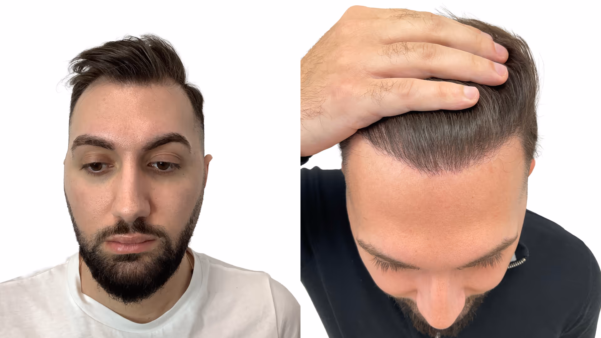 Simon – före och efter sin hårtransplantation